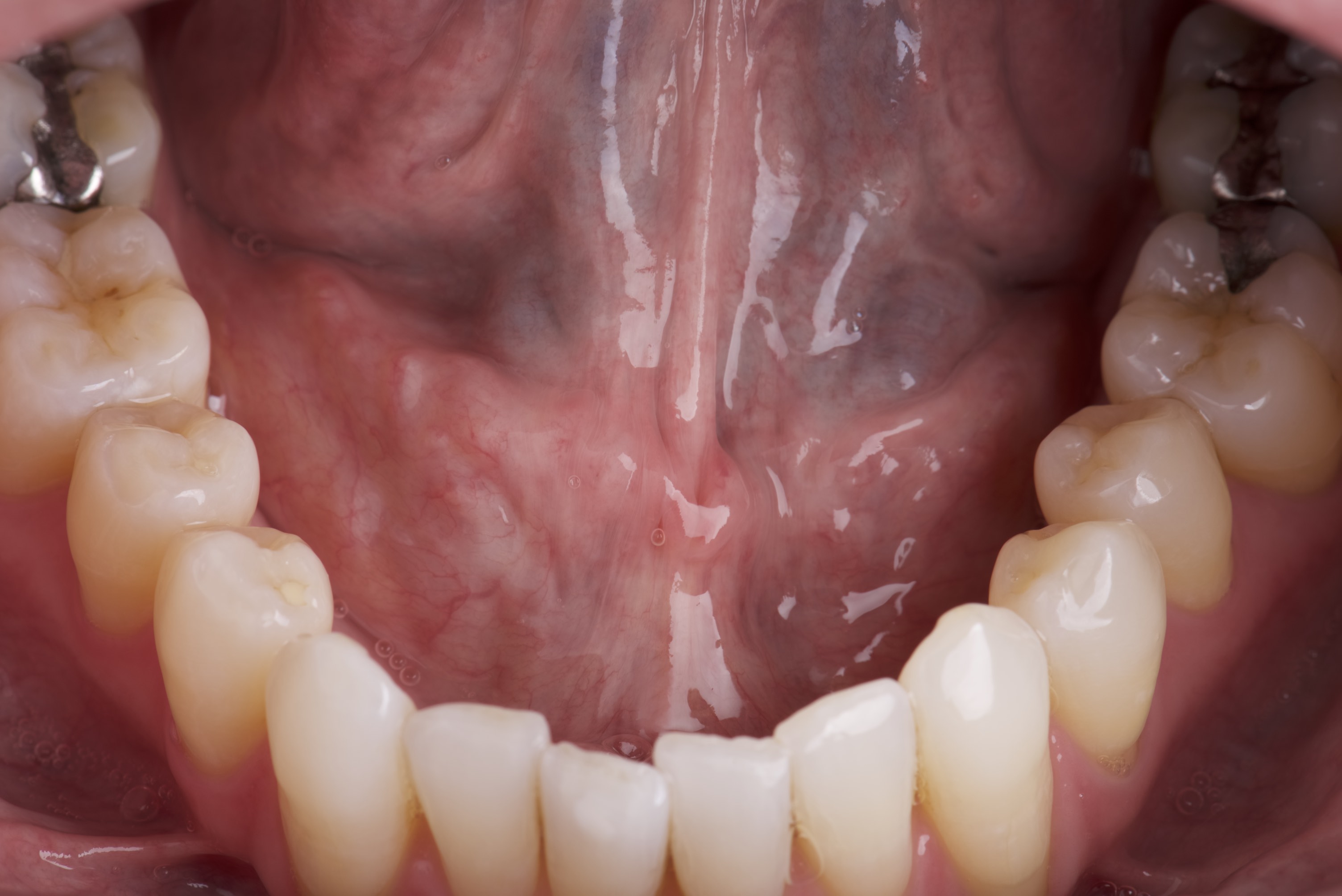 Floor Of Mouth Cancer